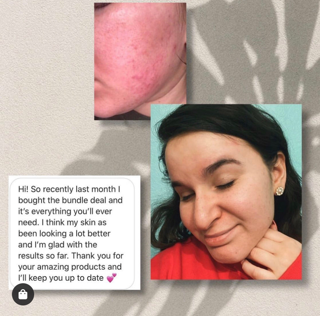 1000 Suns Tea Tree Pimple Extraction Serum