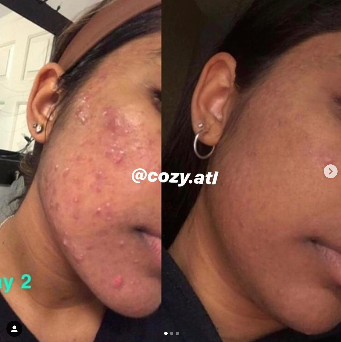 Vitalia Paradoxa Acne + Texture Daily Face Bundle Set