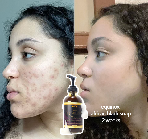 Equinox Dark Spot Corrector Acne Face + Body Wash