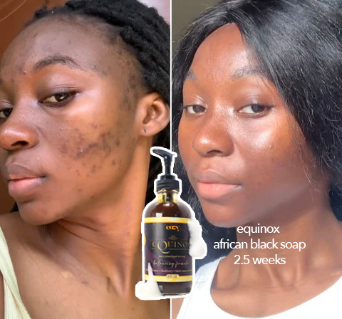 Equinox Dark Spot Corrector Acne Face + Body Wash