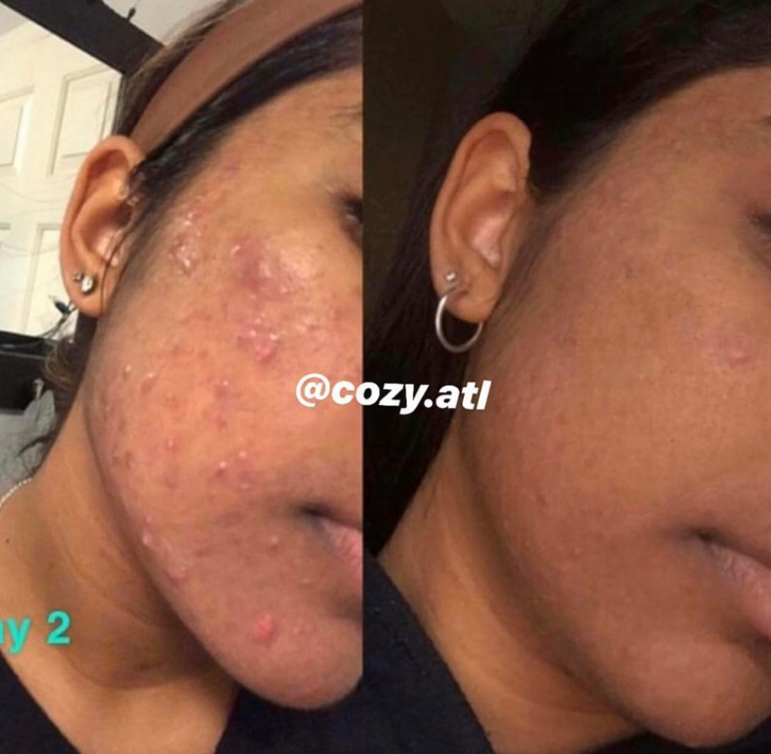 Vitalia Paradoxa Detox Acne Face + Body Wash