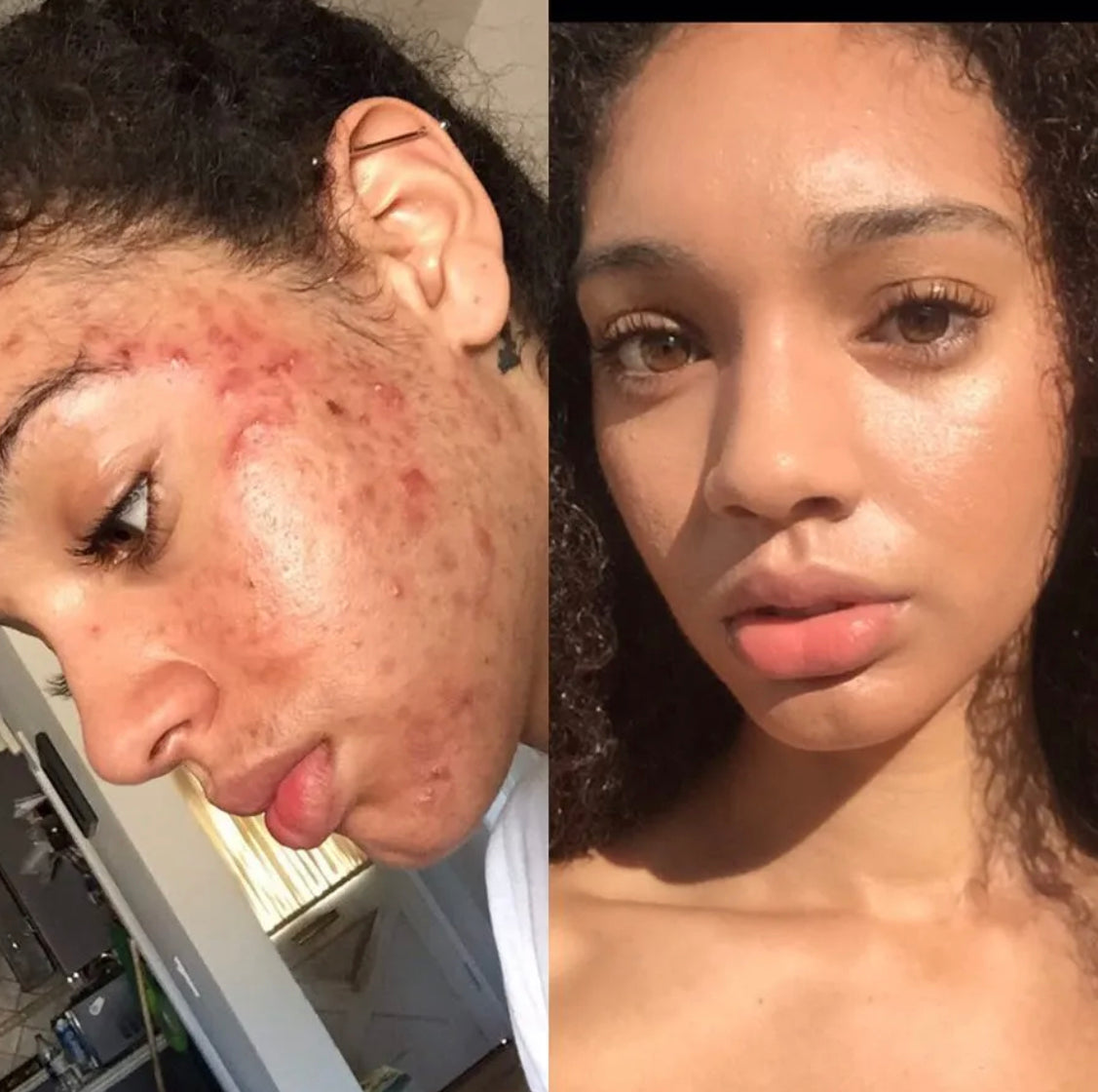 Acne + Texture Daily Face Bundle Set