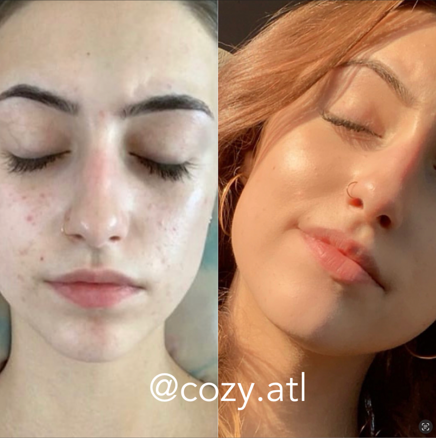 Rain Dance™ Daily  Moisturizer + Vitalia Paradoxa Acne Liquid Soap