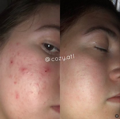 Rain Dance™ Daily  Moisturizer + Vitalia Paradoxa Acne Liquid Soap